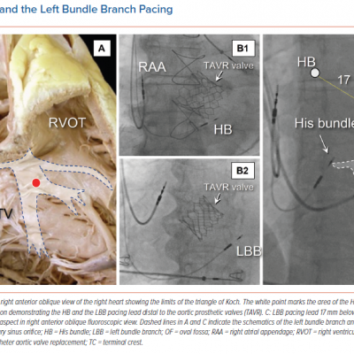 Area of His and the Left Bundle Branch Pacing