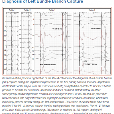 Using the V6–V1 Criterion for the Diagnosis of Left Bundle Branch Capture