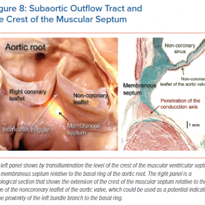 Subaortic Outflow Tract and the Crest of the Muscular Septum