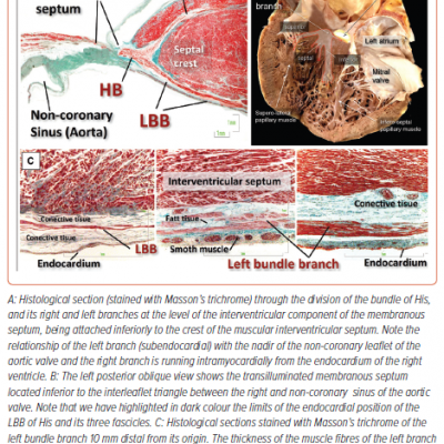 Left Bundle Branch