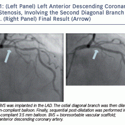 Left Panel Left Anterior Descending Coronary Artery Stenosis Involving the Second Diagonal Branch Arrow. Right Panel Final Result Arrow
