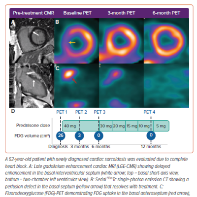 Serial Imaging in a Patient with Recovered AV Node Function After Immunosuppressive Therapy