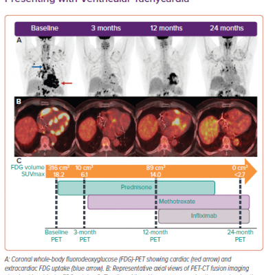 Serial FDG-PET-guided Immunosuppressive Therapy in a Patient with Active Sarcoidosis Presenting with Ventricular Tachycardia