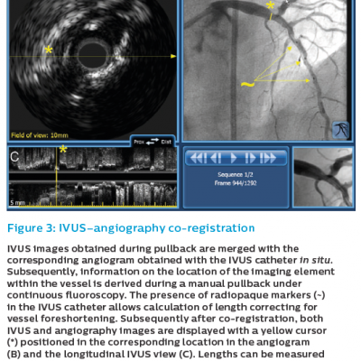 Figure 3 IVUS–angiography co-registration