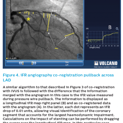 4---figure 4-ifr-angiography-co-reg