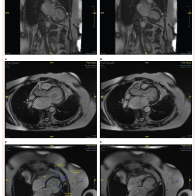 Characteristic Appearances of Isolated Left Ventricle Apical Hypoplasia on Cardiac MRI