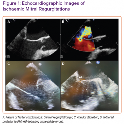 Echocardiographic Images of Ischaemic Mitral Regurgitations