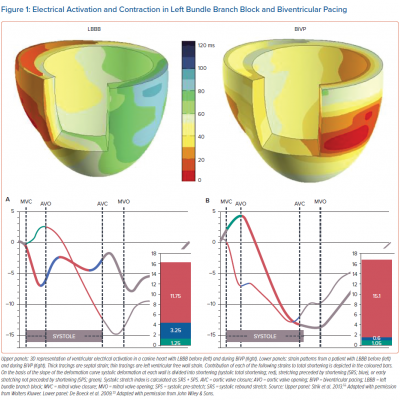 Electrical Activation and Contraction in Left Bundle Branch Block and Biventricular Pacing