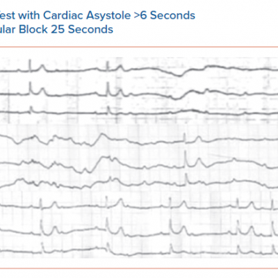 Positive Adenosine Test with Cardiac Asystole &gt6 Seconds and High-degree Atrioventricular Block 25 Seconds