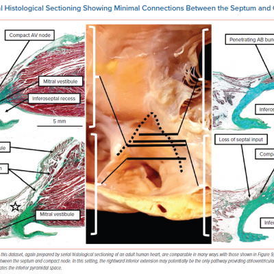 Serial Histological Sectioning Showing Minimal Connections Between the Septum and Compact Node