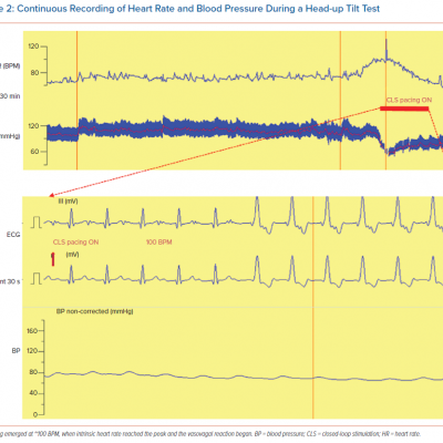 Continuous Recording of Heart Rate and Blood Pressure During a Head-up Tilt Test