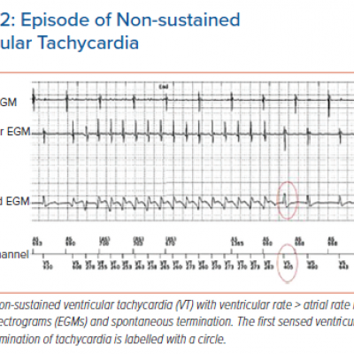 Episode of Non-sustained Ventricular Tachycardia