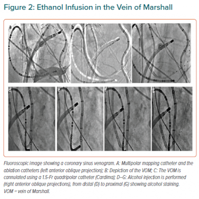 Ethanol Infusion in the Vein of Marshall