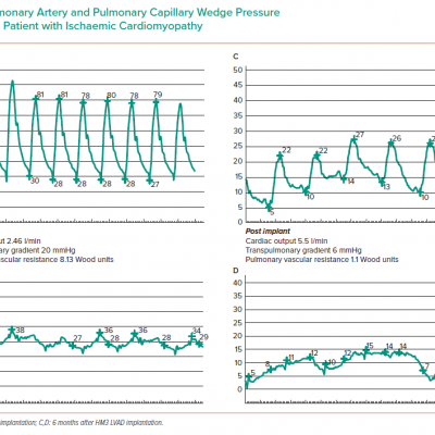 Pulmonary Artery and Pulmonary Capillary Wedge Pressure Traces from a Patient with Ischaemic Cardiomyopathy