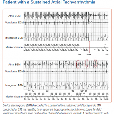 Device Electrograms Recorded in a Patient with a Sustained Atrial Tachyarrhythmia