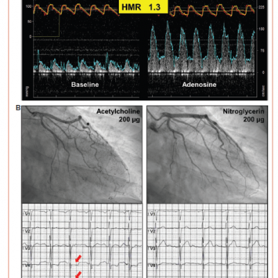 Interventional Diagnostic Procedure in a 33-year-old Male Patient with Repeated Episodes of Resting Angina and Unobstructed Coronary Arteries
