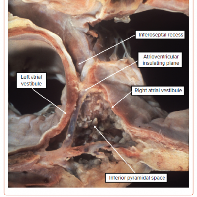 Site of Penetration of the Atrioventricular Conduction Axis
