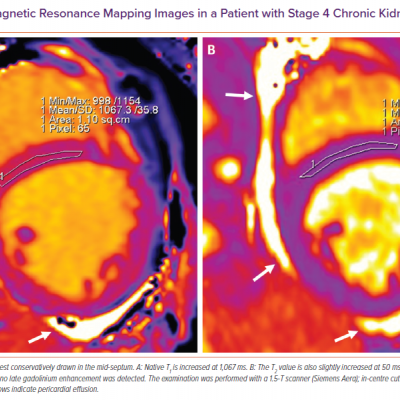 Cardiac Magnetic Resonance Mapping Images in a Patient with Stage 4 Chronic Kidney Disease