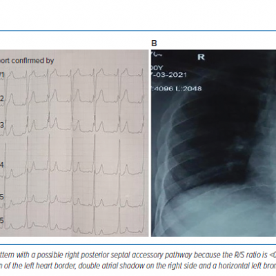 ECG and Chest X-Ray