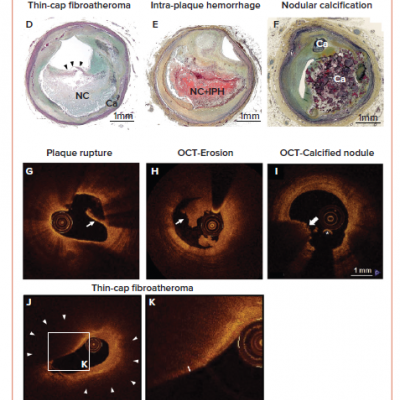 Pathology and Intra-coronary Imaging OCT of Human Coronary Artery Morphologies Associated With ACS
