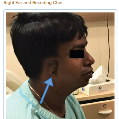Patient with Rudimentary Right Ear and Receding Chin