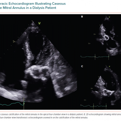 Transthoracic Echocardiogram Illustrating Caseous Calcification of the Mitral Annulus in a Dialysis Patient