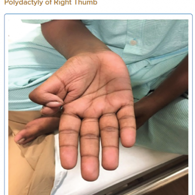 Digital Clubbing with Post-axial Polydactyly of Right Thumb