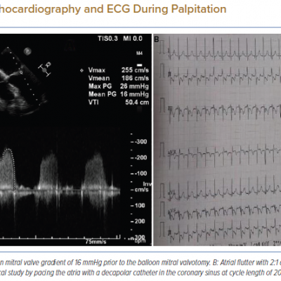 Transesophagial Echocardiography and ECG During Palpitation