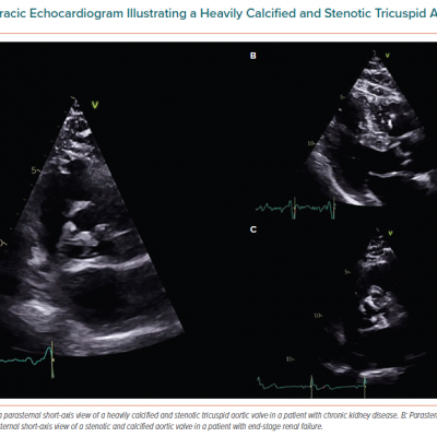 Transthoracic Echocardiogram Illustrating a Heavily Calcified and Stenotic Tricuspid Aortic Valve