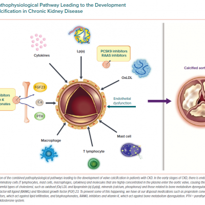 Pathophysiological Pathway Leading to the Development of Valve Calcification in Chronic Kidney Disease