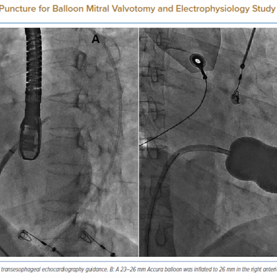Transsepetal Puncture for Balloon Mitral Valvotomy and Electrophysiology Study in One Go