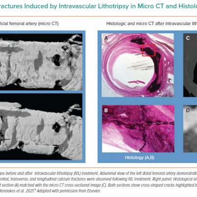 Calcic Microfractures Induced by Intravascular Lithotripsy in Micro CT and Histology 