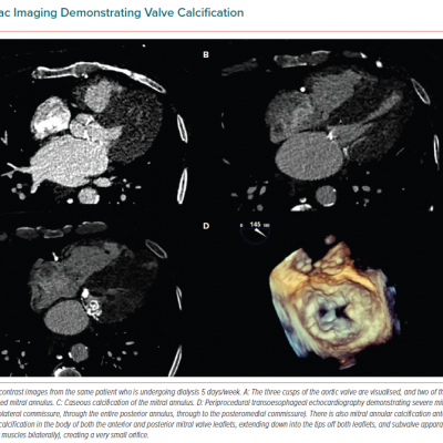 Cardiac Imaging Demonstrating Valve Calcification