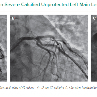 Intravascular Lithotripsy in Severe Calcified Unprotected Left Main Lesion