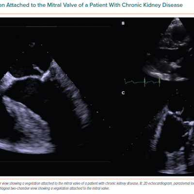 Vegetation Attached to the Mitral Valve of a Patient With Chronic Kidney Disease