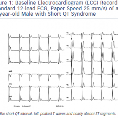 Figure 1 Baseline Electrocardiogram ECG Recording Standard 12-lead ECG Paper Speed 25 mm/s of a 25-year-old Male with Short QT Syndrome