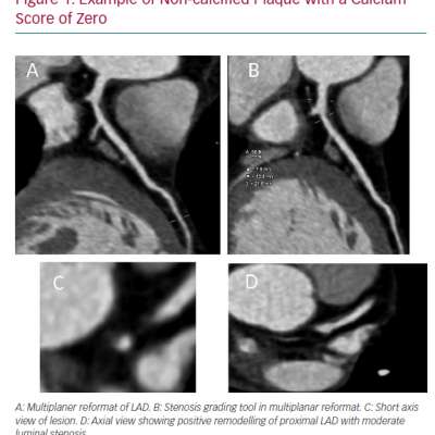 Example of Non-calcified Plaque with a Calcium Score of Zero