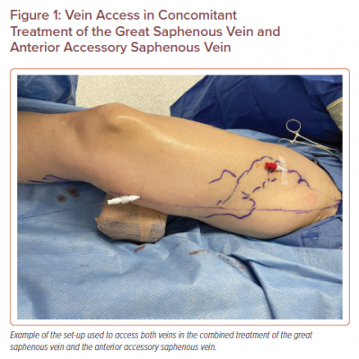 Vein Access in Concomitant Treatment of the Great Saphenous Vein and Anterior Accessory Saphenous Vein