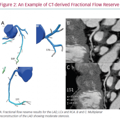 An Example of CT-derived Fractional Flow Reserve