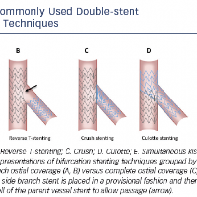 Figure 2 Commonly Used Double-stent Bifurcation Techniques