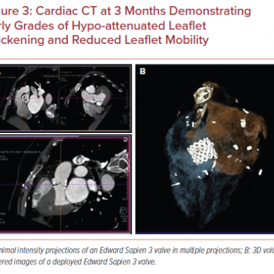 Cardiac CT at 3 Months Demonstrating Early Grades of Hypo-attenuated Leaflet Thickening and Reduced Leaflet Mobility