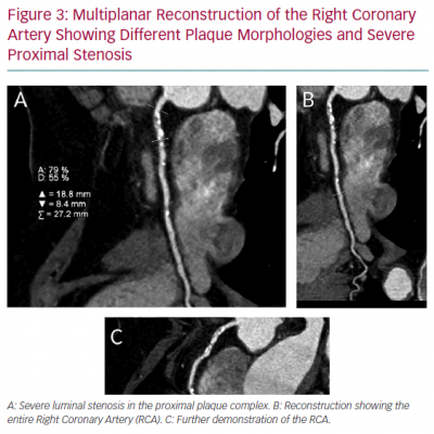 Multiplanar Reconstruction of the Right Coronary Artery Showing Different Plaque Morphologies and Severe Proximal Stenosis