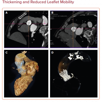 Cardiac CT at 3 Months Demonstrating the Absence of Hypo-attenuated Leaflet Thickening and Reduced Leaflet Mobility
