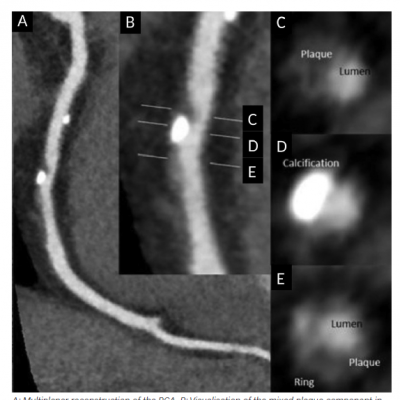 Example of Different Plaque Morphology on Coronary CT
