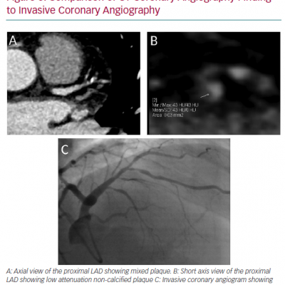 Comparison of CT Coronary Angiography Finding to Invasive Coronary Angiography