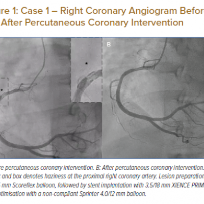 Case 1 – Right Coronary Angiogram Before and After Percutaneous Coronary Intervention