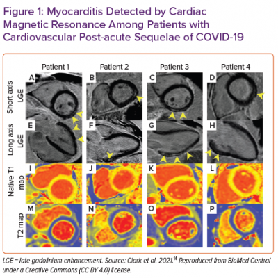 Myocarditis Detected by Cardiac Magnetic Resonance Among Patients with Cardiovascular Post-acute Sequelae of COVID-19