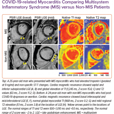 Cardiac Magnetic Resonance Features of COVID-19-related Myocarditis Comparing Multisystem Inflammatory Syndrome MIS versus Non-MIS Patients