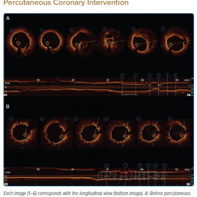 Case 1 – Optical Coherence Tomography Evaluation Before and After Percutaneous Coronary Intervention
