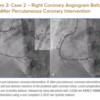 Case 2 – Right Coronary Angiogram Before and After Percutaneous Coronary Intervention